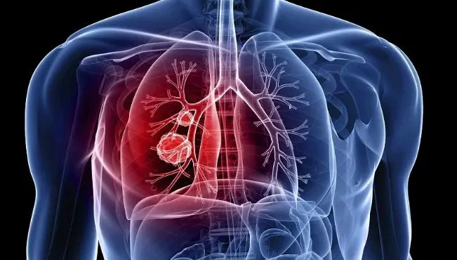 Comitê vai acompanhar encomenda tecnológica para teste portátil de tuberculose